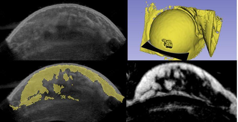 825px Breast 3Drecon