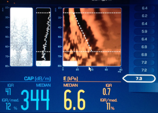 550px MUSIC Fibroscan